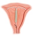 Una spirale intrauterina (IUD) con ormoni inserita nell'utero