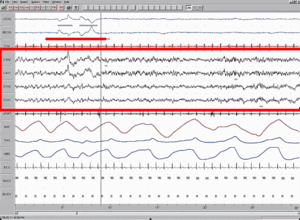 Polysomnographic record of REM Sleep. EEG highlighted by red box. Eye movement highlighted by red line. Sleep EEG REM.png