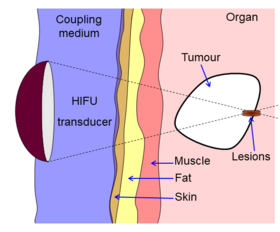 Diagram showing liver lesioning using a HIFU transducer 2.png