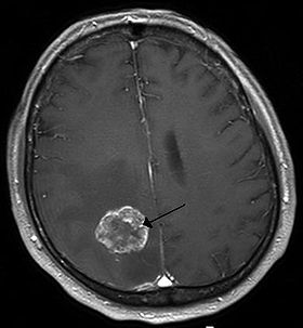 Hirnmetastase MRT-T1 KM.jpg