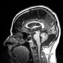 Sagittal view of a human brain through MRI MRI EGC sagittal.png