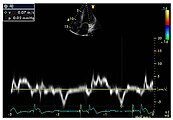 Gewebedoppler-Echokardiographie des Mitralanulus (Mitralring) mit nahezu normaler systolischer Funktion