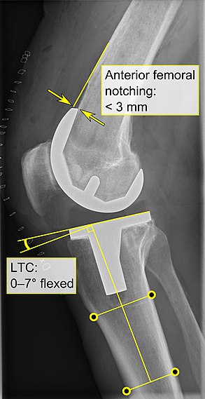 - Anterior femoral notching (the femoral component causing reduced thickness of the distal femur anteriorly), seems to cause an increased risk of fractures when exceeding about 3 mm.[57]​ - LTC: lateral (or sagittal) tibial component angle, which is ideally positioned so that the tibia is 0–7° flexed compared to at a right angle with the tibial plate.[56]​