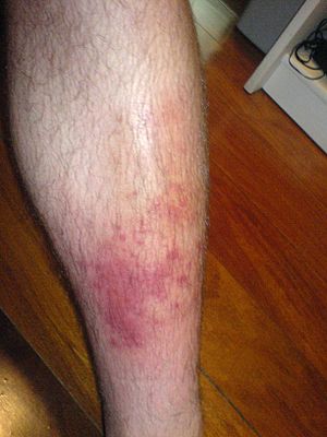 Cellulitis3.jpg