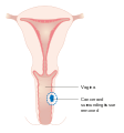A local surgery to remove vaginal cancer