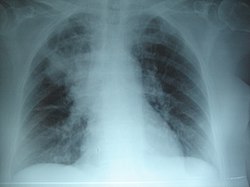 ذات الرئة السفلي الأيمن: يُؤدي التليف الكيسي المُزمن إلى تدمير النسيج البرانشيمي للرئة، مُسببًا في النهاية موت المريض نتيجة لتليف الجهاز التنفسي.