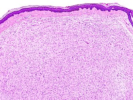 Гистологическое изображение кожной нейрофибромы