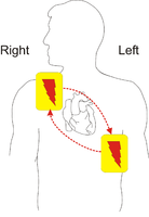 一般的なAEDの、電気パッドの取り付け位置。胸の右上と、左下に貼る。