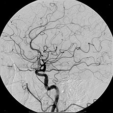 Cerba Angiogram Lateral.jpg