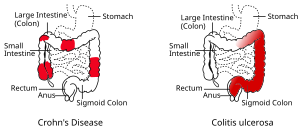 Crohnova choroba vs Colitis ulcerosa.svg