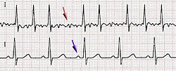 ECG של פרפור עליות (למעלה) ושל קצב סינוס רגיל (למטה). החץ הסגול מצביע על גל P, אשר אינו קיים במקרה של פרפור עליות.