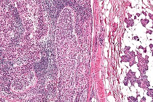 Sebaceous carcinoma - intermed mag.jpg