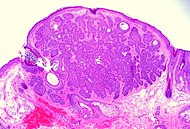 Trichoepithelioma (1338537528) .jpg