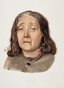 An 1892 lithograph of a woman diagnosed with melancholia A woman diagnosed as suffering from melancholia. Colour lith Wellcome L0026686.jpg