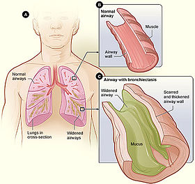 Bronchiectasis NHLBI.jpg