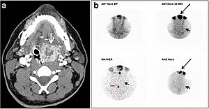 CT и сцинтиграфия на лингвална ектопична щитовидна жлеза.jpg