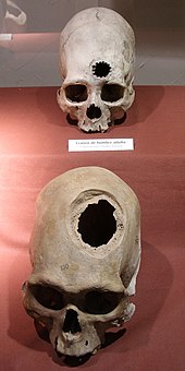 Trepanned Incan skulls Incan Brain Surgery.jpg