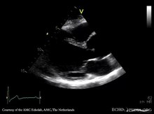 Soubor: Marfanův syndrom E00551 (CardioNetworks ECHOpedia) .webm