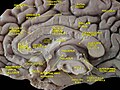 Storhjernen delt i to. Hjernenhalvdel vist frå indre sida. Djup disseksjon.