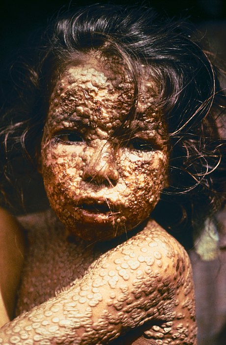 460px-Child_with_Smallpox_Bangladesh.jpg