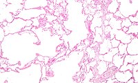 Micrograph of an emphysematous lung; emphysema is a common respiratory disease, strongly associated with smoking. H&E stain.Respiratory disease