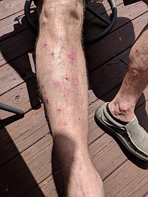 Legs Bullous Pemphigoid.jpg