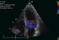 Файл: The-best-of-2005-in-echocardiography-back-from-EuroEcho-9 -–- Florence-Italy-1476-7120-4-11-S2.ogv