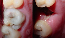 Dua gambar yang menunjukkan gigi dengan karies lesi besar, dan soket kiri sekali gigi telah diekstrak