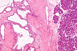 صورة مجهرية تظهر ورم غدي كيسي مصلي في البنكرياس. صبغة الهيماتوكسيلين واليوزين.