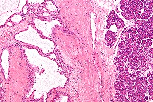 Pancreatic serous cystadenoma - intermed mag.jpg