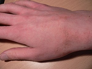 What are the symptoms of a scabies infection?