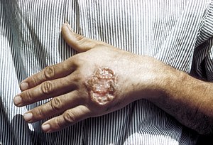 Skin ulcer due to leishmaniasis, hand of Central American adult 3MG0037 lores.jpg