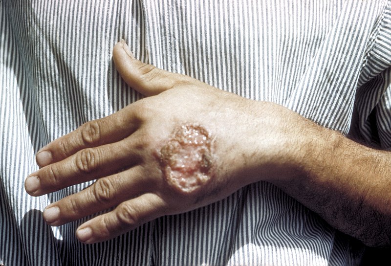 Ficheiro:Skin ulcer due to leishmaniasis, hand of Central American adult 3MG0037 lores.jpg