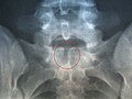 Rendgenski snimak skrivene spina bifida na S-1