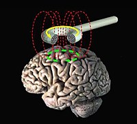 Transcranial magnetic stimulation uses magnetism to safely stimulate or inhibit parts of the brain. Transcranial magnetic stimulation.jpg