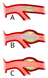 100px-Angioplasty-scheme.svg.png