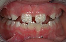 Irreversible enamel defects caused by an untreated celiac disease. They may be the only clue to its diagnosis, even in absence of gastrointestinal symptoms, but are often confused with fluorosis, tetracycline discoloration, acid reflux or other causes. The National Institutes of Health include a dental exam in the diagnostic protocol of celiac disease. Enamel celiac.jpg