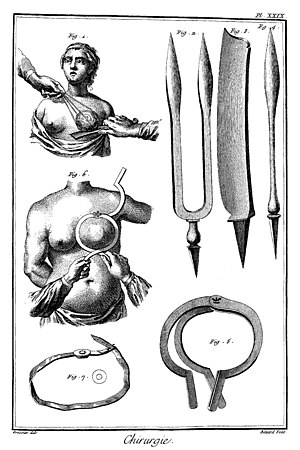 breast cancer surgery in 18. century