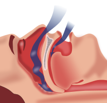 Nákres uzáveru dýchacích ciest počas spánkového apnoe