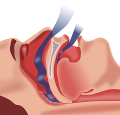 Obstruction ventilation apnée sommeil.svg