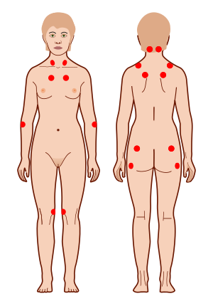 Точки чувствительности fibromyalgia.svg