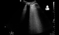 File:UOTW 7 - Ultrasound of the Week 2.webm