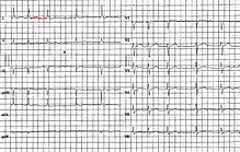 EKG-fibrilácia predsiení