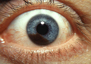 English: Photograph of an iris melanoma