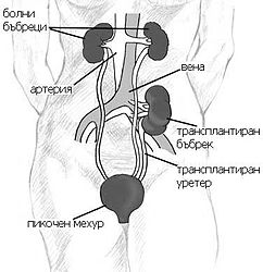 Схема на бъбречна трансплантация