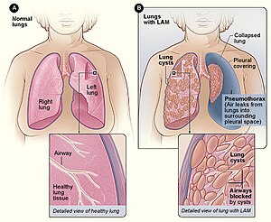 Lymphangioleiomyomatosis.jpg