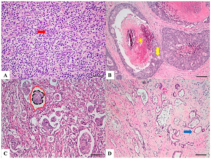 H&E stained sections: (A)Lymphoepitelioma-like carcinoma: Poorly differentiated cells (red arrow) arranged in solid nests, tubules and trabeculae with poorly demarcated, infiltrative margins; intratumoral lymphoid infiltrate is extremely abundant. (B) Cribiform comedo-type carcinoma: Cribriform gland (yellow arrow) with central necrosis comedo-like (yellow asterisk). (C) Micropapillary carcinoma: Small, tight round to oval cohesive clusters of neoplastic cells (>5 cells) floating in clear spaces (double circle red-black), without endothelial lining and with no evidence of inflammatory cells. (D) Low grade tubulo-glandular carcinoma: Very well-differentiated invasive glands with uniform circular or tubular profiles (blue arrow) with bland cytologic atypia.[9]