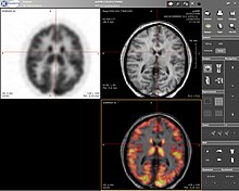 Imaxe combinada de IRM e PET do cerebro humano.