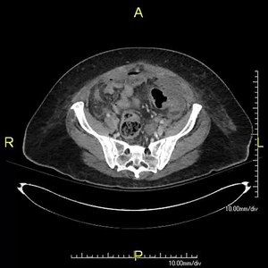 File:Stercoral perforation CT cine clip.webm
