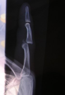 Radiograph of left index finger dislocation